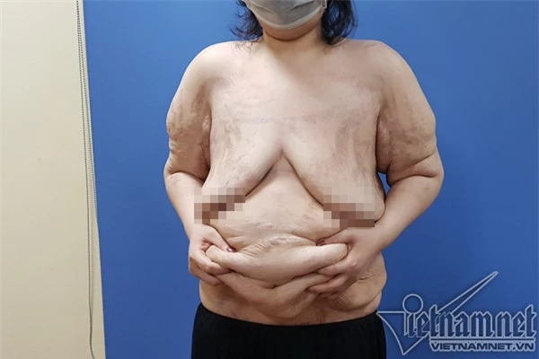Người phụ nữ vòng ngực 1m được phẫu thuật thay đổi vóc dáng