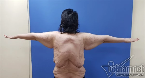 Người phụ nữ vòng ngực 1m được phẫu thuật thay đổi vóc dáng