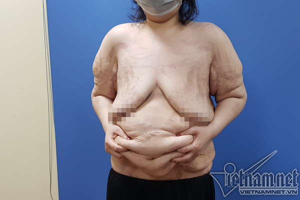 Người phụ nữ vòng ngực siêu khủng 1m ở Hà Nội được phẫu thuật thay đổi vóc dáng