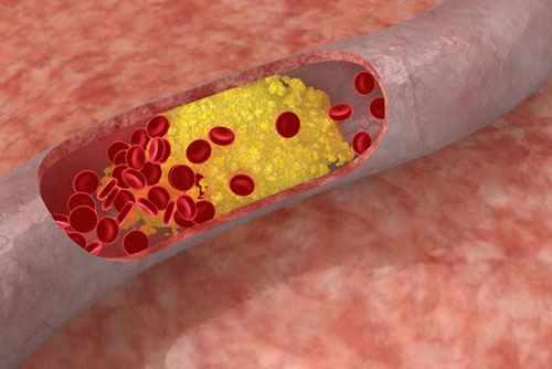Người bị máu nhiễm mỡ cần làm gì để không bị tái phát