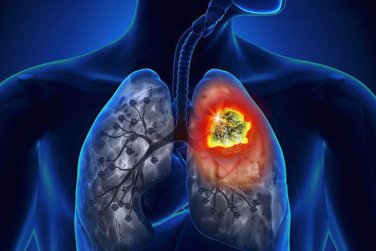 Tiến bộ mới trong điều trị ung thư phổi không tế bào nhỏ