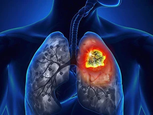Tiến bộ mới trong điều trị ung thư phổi không tế bào nhỏ