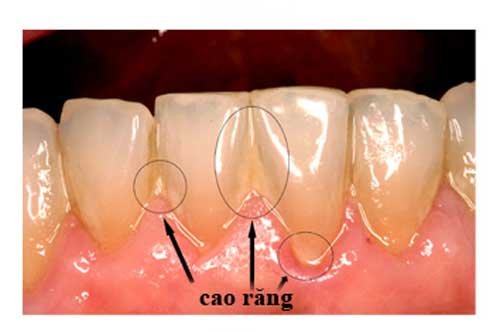 Cao răng bong ra từng mảng, trả lại hàm răng trắng như bọc sứ chỉ trong 5 phút