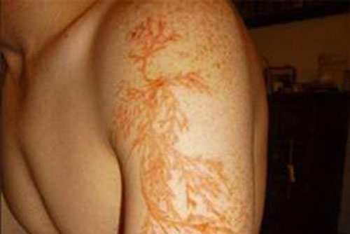 Những triệu chứng kỳ lạ sau tai nạn sét đánh