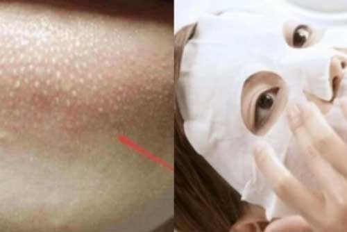 Kém xinh vì cằm dày đặc và toàn hạt trắng, chỉ với 3 bước này, tất cả đều sạch bong