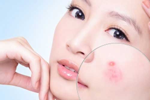 Mụn biến mất hoàn toàn chỉ sau 1 đêm với những nguyên liệu vài nghìn đồng này