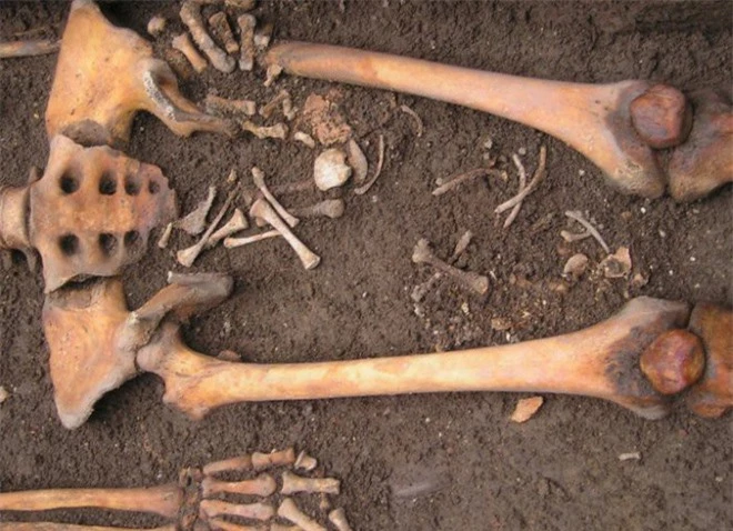 Đầu và thân mình của đứa bé nằm giữa hai xương đùi người mẹ, trong khi đó, xương chân vẫn nằm trong khoang chậu.