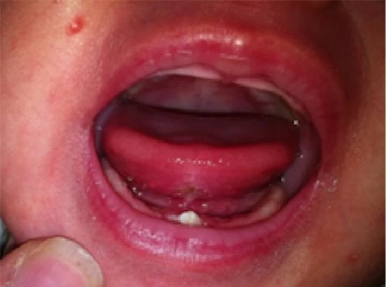 Thông thường răng sơ sinh sẽ được chỉ định loại bỏ (Ảnh minh họa)