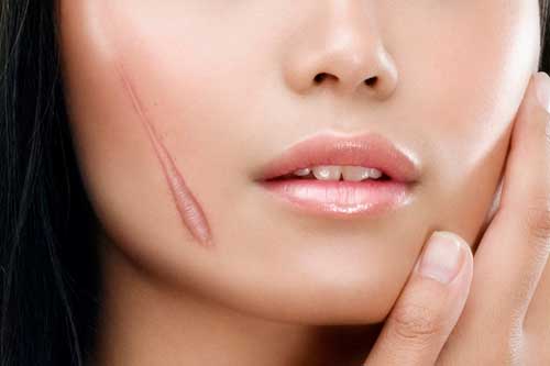 Da trắng không tỳ vết, sẹo lồi lõm được 'là phẳng' hoàn toàn chỉ với cách làm cực rẻ tiền này