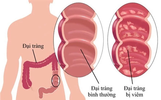 Viêm đại tràng là bệnh tiêu hóa thường gặp