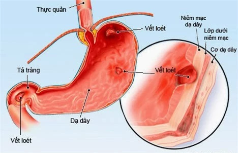 Món ăn thanh đạm, ít tốn kém có tác dụng trị viêm dạ dày cấp tính - Ảnh 1 Viêm dạ dày cấp là tình trạng sưng, viêm đột ngột trong niêm mạc dạ dày