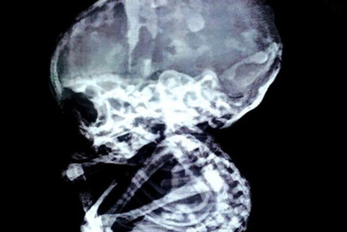 'Kinh hãi' trước cảnh 15 năm sau khi phá thai, bào thai vẫn còn nguyên trong bụng mẹ