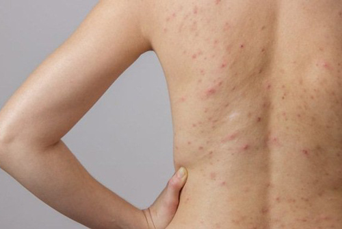 Viêm nang lông - bạn đã biết cách trị?