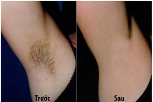 Tuyệt chiêu khiến lông nách biến mất vĩnh viễn trong 2 phút không cần nhíp