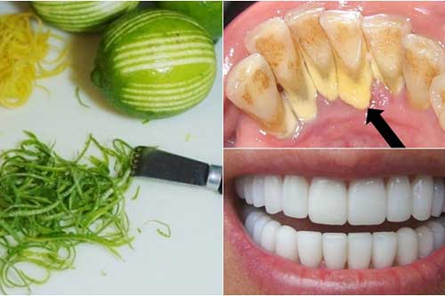 Đánh bay cao răng “vàng ruộm” chỉ bằng bài thuốc từ vỏ chanh và giấm