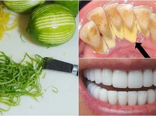 Đánh bay cao răng “vàng ruộm” chỉ bằng bài thuốc từ vỏ chanh và giấm