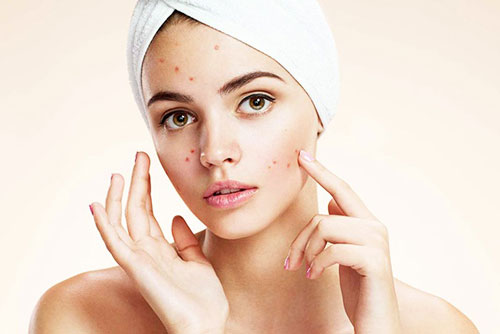 Bỏ ngay những thói quen dưới đây nếu không muốn mụn đeo bám dai dẳng