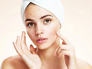 Bỏ ngay những thói quen dưới đây nếu không muốn mụn đeo bám dai dẳng