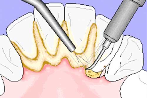 Răng ố vàng trở nên sạch bong sau vài giây nhờ loại rau thơm này