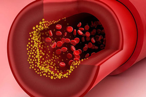 Cách loại bỏ cholesterol xấu gây hại cho sức khỏe