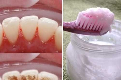 Tuyệt chiêu đánh bật cao răng, hiệu quả tức thì chỉ với một ít dấm ăn