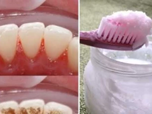 Tuyệt chiêu đánh bật cao răng, hiệu quả tức thì chỉ với một ít dấm ăn