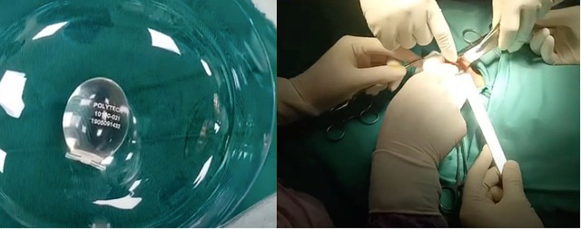 Nam sinh Hà Nội đặt tinh hoàn nhân tạo để tự tin với bạn gái