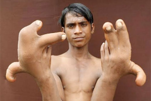 Cậu bé Ấn Độ mắc bệnh "quỉ ám" khiến mọi người khiếp sợ