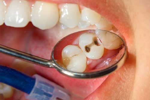 Thấy răng xuất hiện điểm "lạ" này cần đi kiểm tra càng sớm càng tốt, chớ vội coi thường