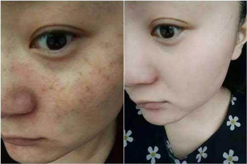 Chỉ với nắm rau chưa đến 3 nghìn da đen nhẻm, thâm nám cũng biến mất hoàn toàn