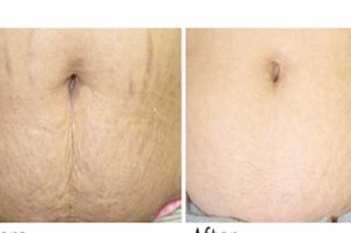 Rạn da lâu năm đến mấy cũng mờ dần với bí quyết dưới đây