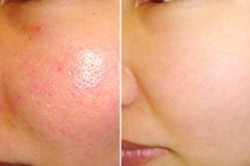 Nấu nồi nước sả gừng rồi xông mặt, lỗ chân lông to đến mấy cũng se "khít khìn khịt" chỉ sau 3 ngày