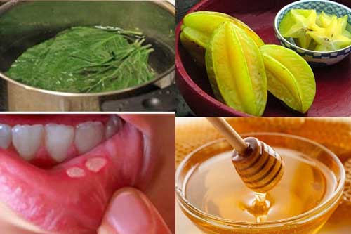 Chỉ cần mẹo nhỏ này nhiệt miệng biến mất trong vòng 1 đêm