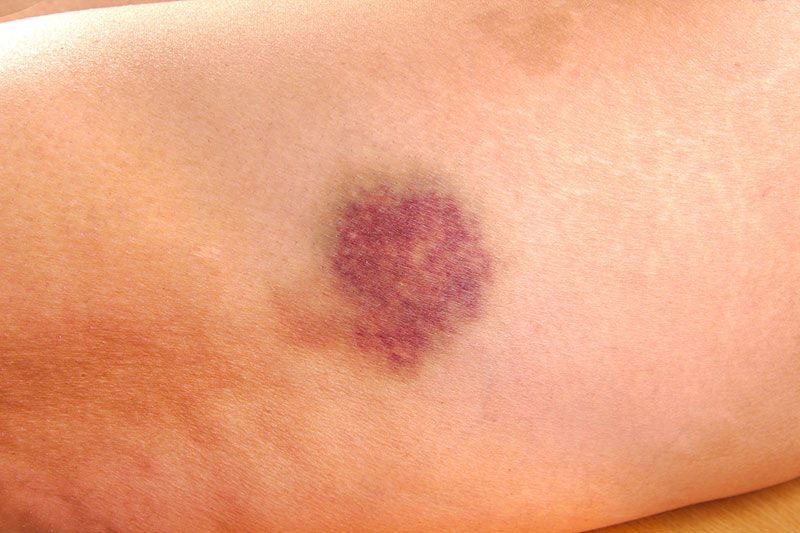 Những biểu hiện của bệnh ung thư mà nhiều người thường bỏ qua