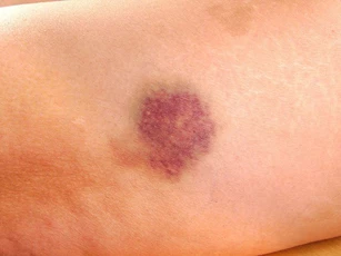 Những biểu hiện của bệnh ung thư mà nhiều người thường bỏ qua