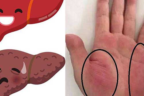 3 dấu hiệu trên bàn tay cảnh báo sớm ung thư gan