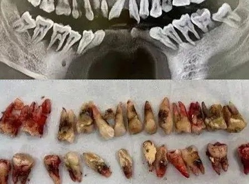 Người đàn ông 31 tuổi phải nhổ tất cả răng vì sai lầm từ 2 năm trước