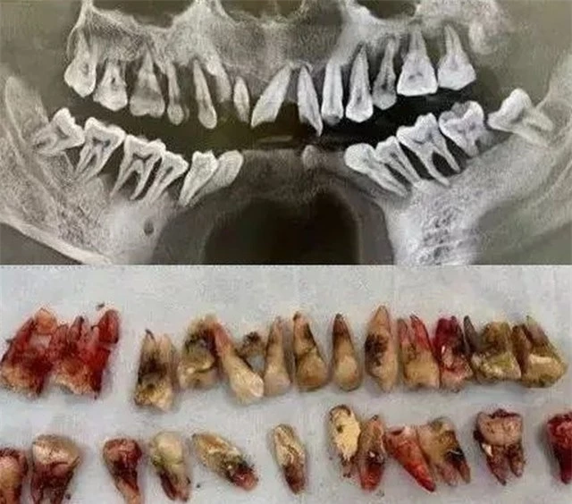 Người đàn ông 31 tuổi đi khám vì răng lung lay, bác sĩ quyết định nhổ tất cả răng vì sai lầm từ 2 năm trước của anh - Ảnh 1.