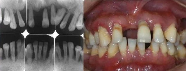 Người đàn ông 31 tuổi đi khám vì răng lung lay, bác sĩ quyết định nhổ tất cả răng vì sai lầm từ 2 năm trước của anh - Ảnh 3.