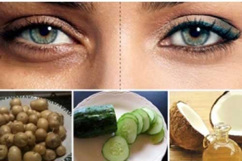 5 cách đơn giản để loại bỏ quầng thâm, bọng mắt hiệu quả nhất