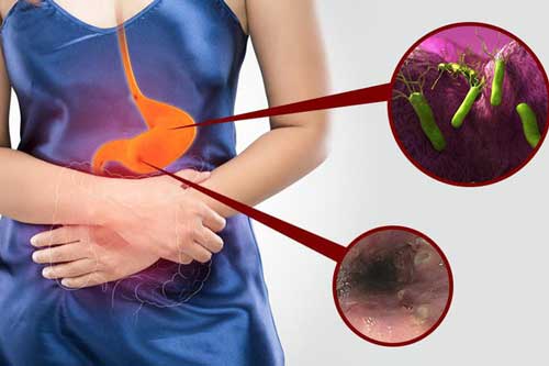 5 thực phẩm cực hại dạ dày, nhiều người Việt mê mẩn ăn hằng ngày