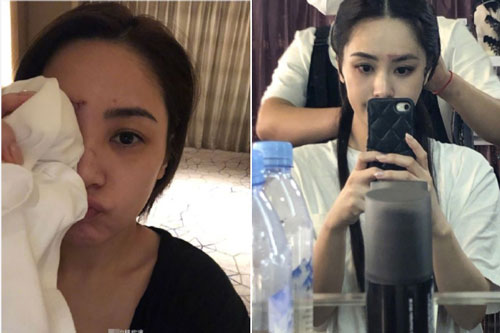 Mặt Chung Hân Đồng bị vết sẹo dài