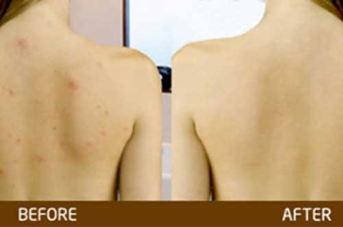 Trị sạch mụn lưng trong vòng "1 nốt nhạc" với bột đậu đỏ