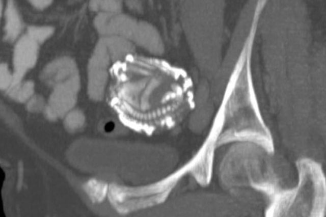 Hơn 60 năm mang nỗi đau "không biết đẻ con", sau một cú vấp ngã, cụ bà đi khám mới ngỡ ngàng với kết quả siêu âm hóa giải mọi thắc mắc