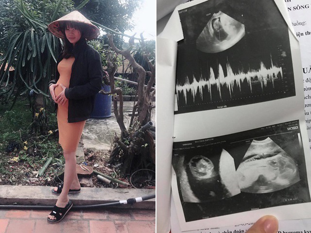 Bác sĩ bắt bỏ vì thai dị tật, mẹ 9X quyết giữ con đến cùng và cái kết có hậu
