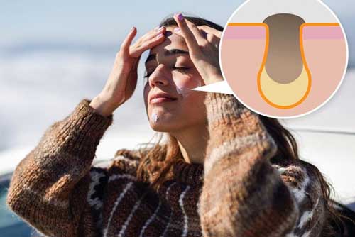 7 sai lầm chăm sóc da khiến mụn thi nhau “ghé thăm”