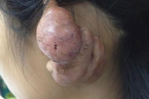 Bấm lỗ tai và hàng loạt biến chứng đáng sợ khiến ai cũng rùng mình