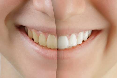 Mẹo biến răng vàng ố lâu ngày, miệng hôi khó chịu thành trắng sáng trong tích tắc