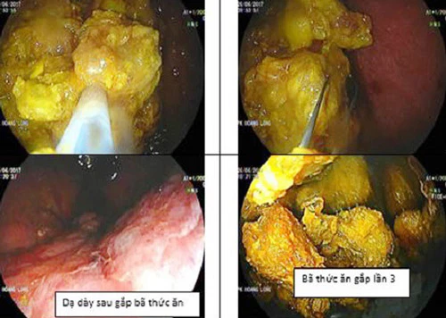  Hình ảnh bã thức ăn trong ruột bệnh nhân do uống tinh bột nghệ.