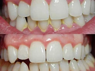 Chỉ cần dành 3 phút buổi tối làm điều này, cả đời chẳng phải đến nha sỹ lấy cao răng